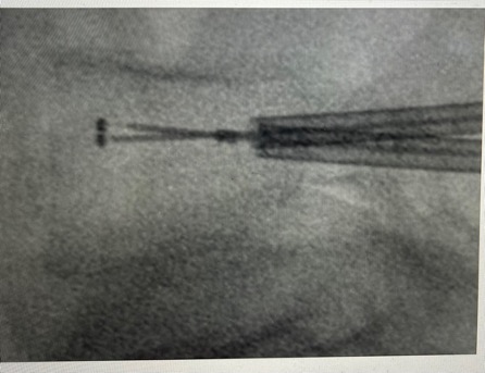 Dr Sébastien Lévy Chirurgie Percutanée 