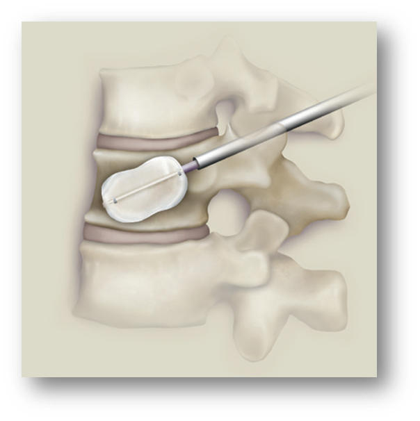 Dr Sébastien Lévy Chirurgie Percutanée 